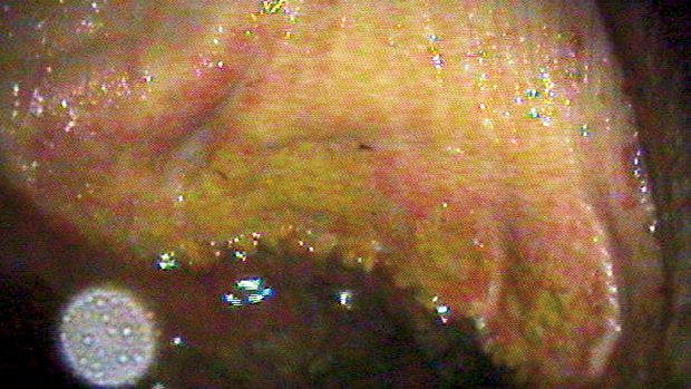 Gastric ulcers ulcer